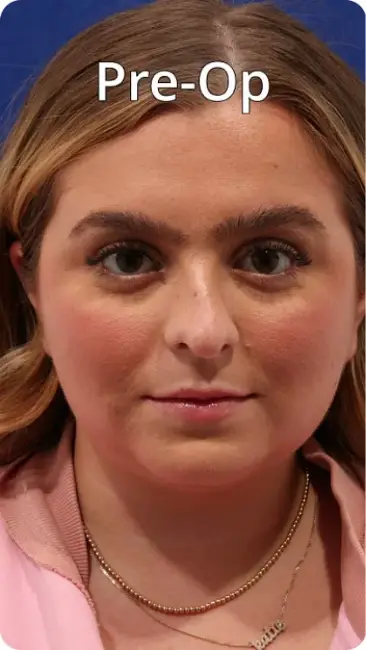 Woman with light brown hair facing forward, labeled as pre-operation.