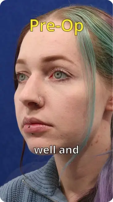 Woman with multicolored hair and piercings faces left as text reads Pre-Op.